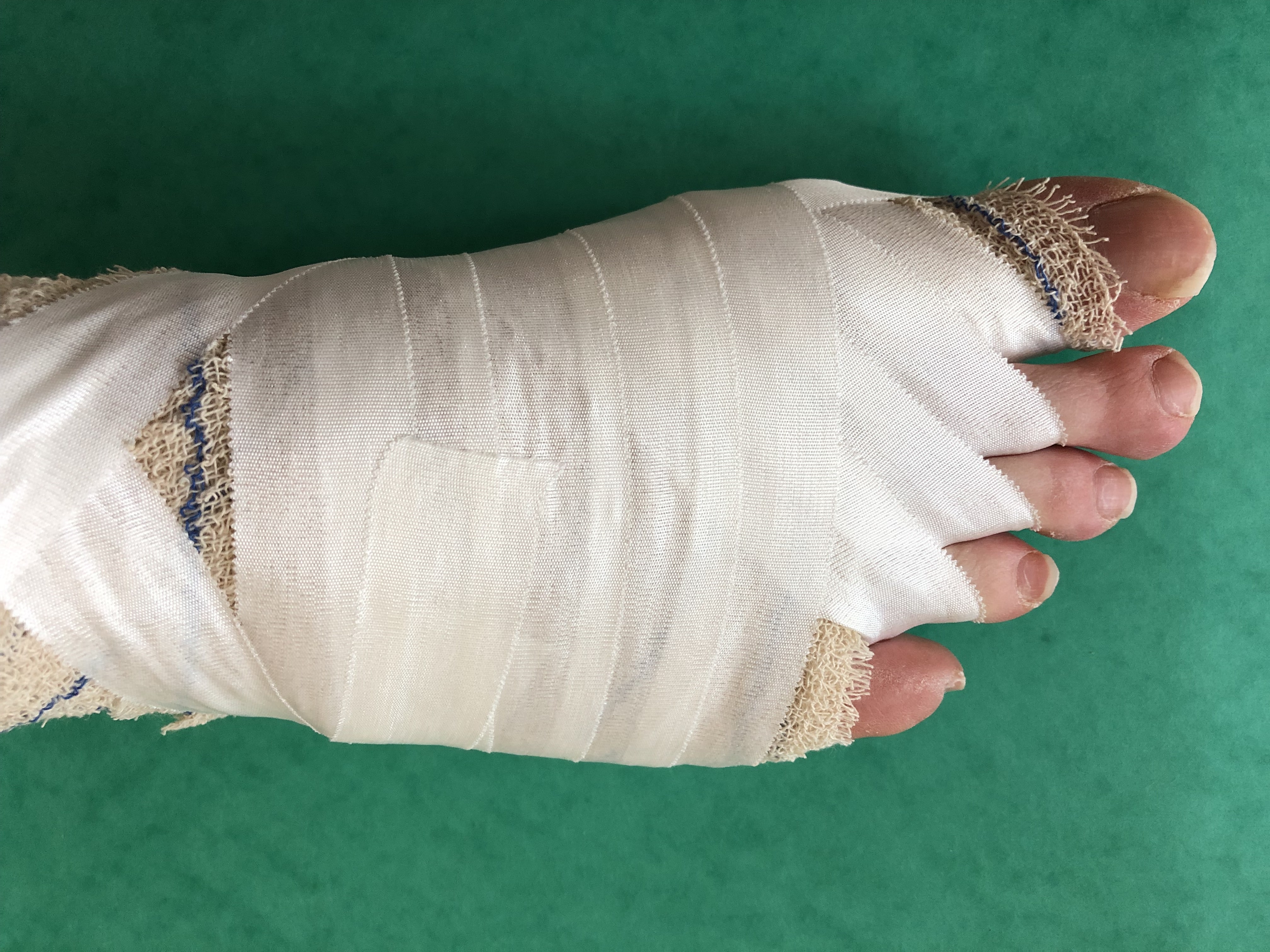 operationpieds Hallux Valgus